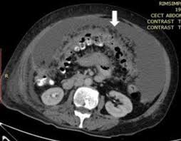 Carcinomatosis peritoneal