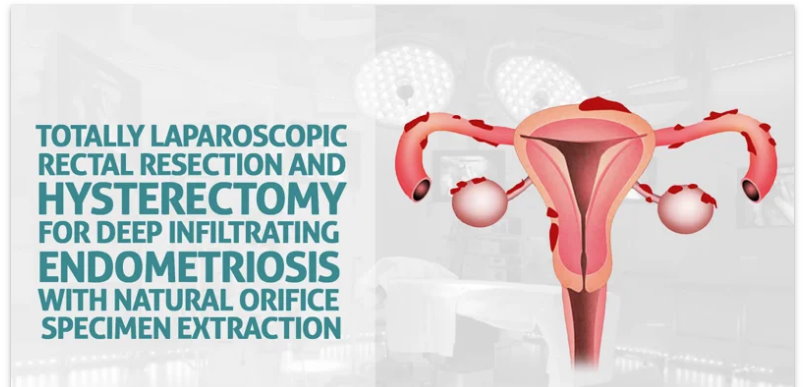 Resección rectal totalmente laparoscópica e histerectomía para endometriosis infiltrante profunda